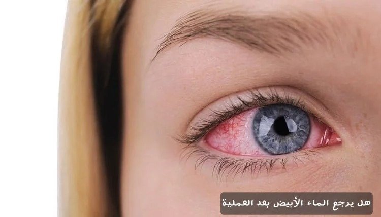 هل
 يرجع الماء الأبيض بعد العملية