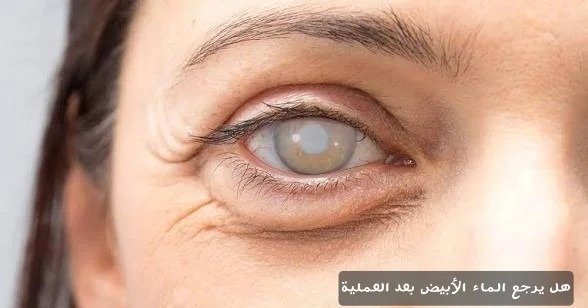 هل يرجع الماء الأبيض بعد العملية