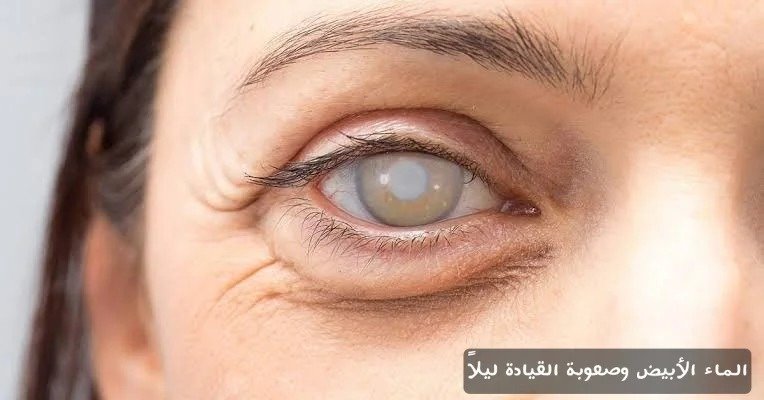 الماء الأبيض وصعوبة القيادة ليلاً