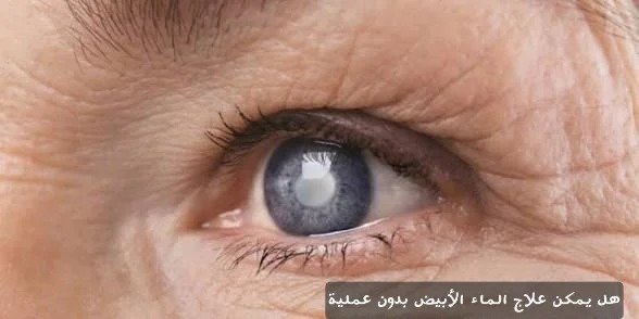 هل يمكن علاج الماء الأبيض بدون عملية